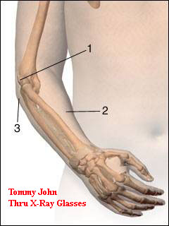 Tommy John Surgery